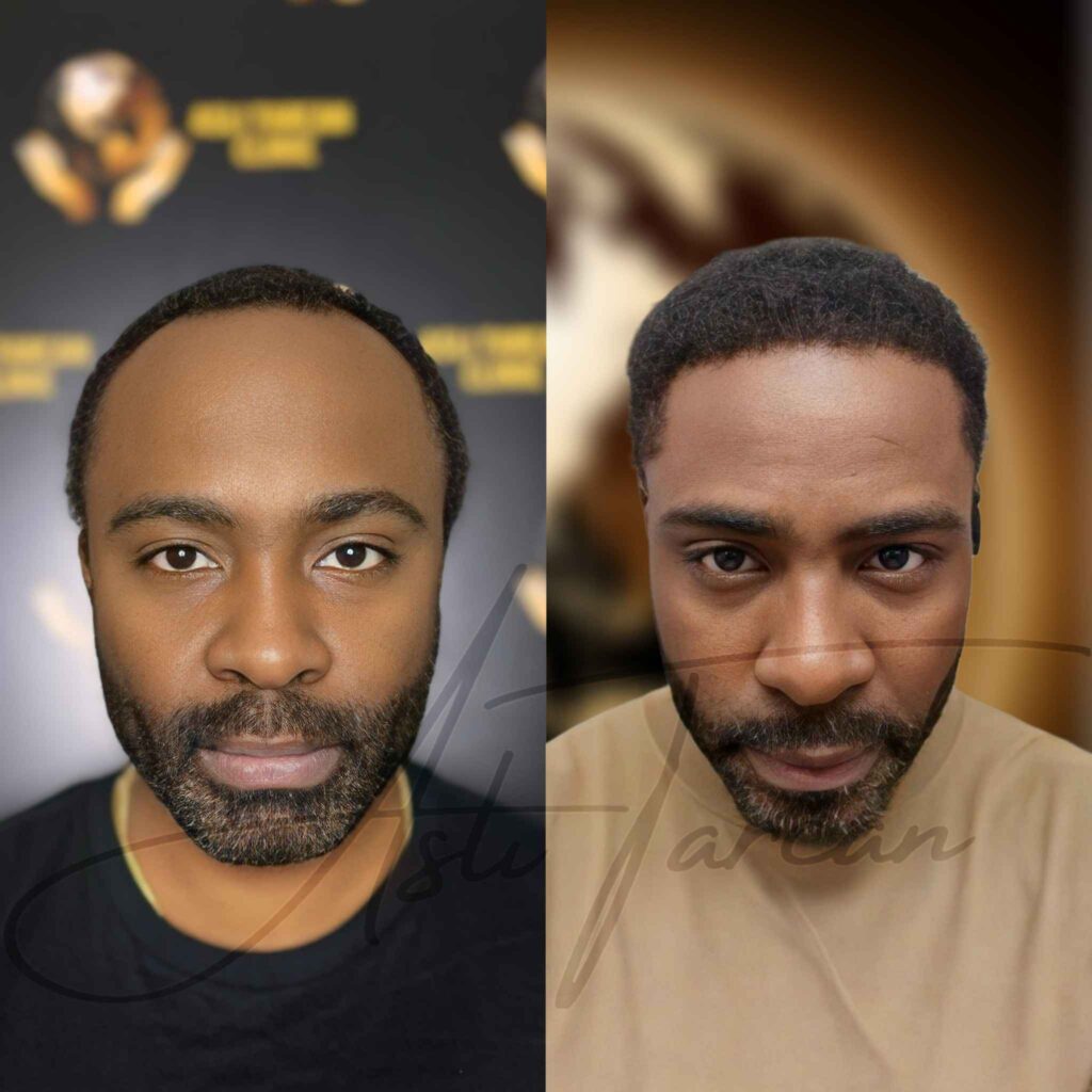 Afro-Haartransplantation-Turkei-vorher-nachher.jpeg