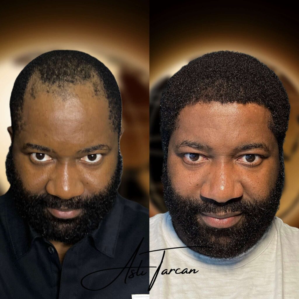 Top-5-best-afro-hair-transplant-turkey-1.jpg