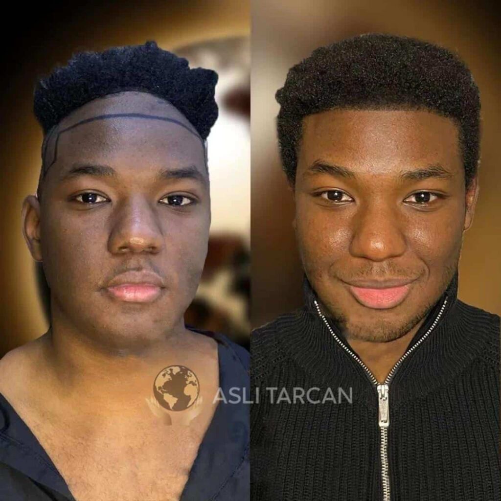 best-afro-hair-transplant-before-and-after-1.jpg
